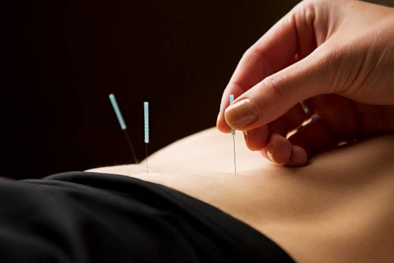 Acupuntura Cervical Consulta Ingá