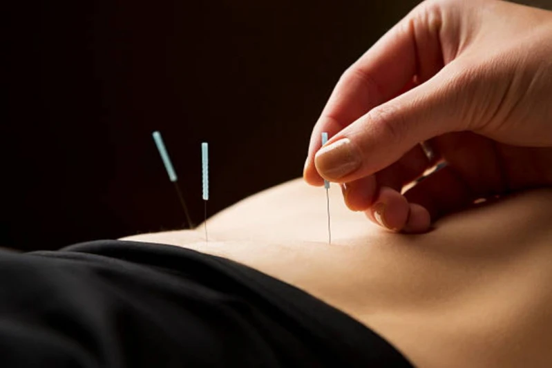 Acupuntura Maracanã